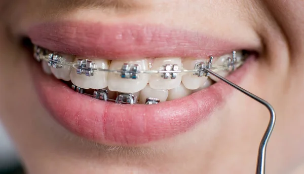 Female patient with metal brackets — Stock Photo, Image