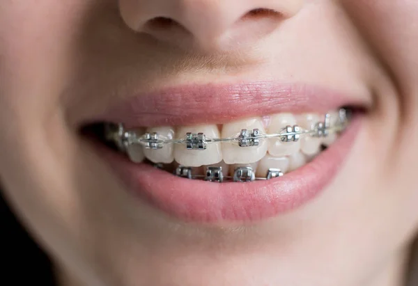 Patient with brackets at the dental office. — Stock Photo, Image