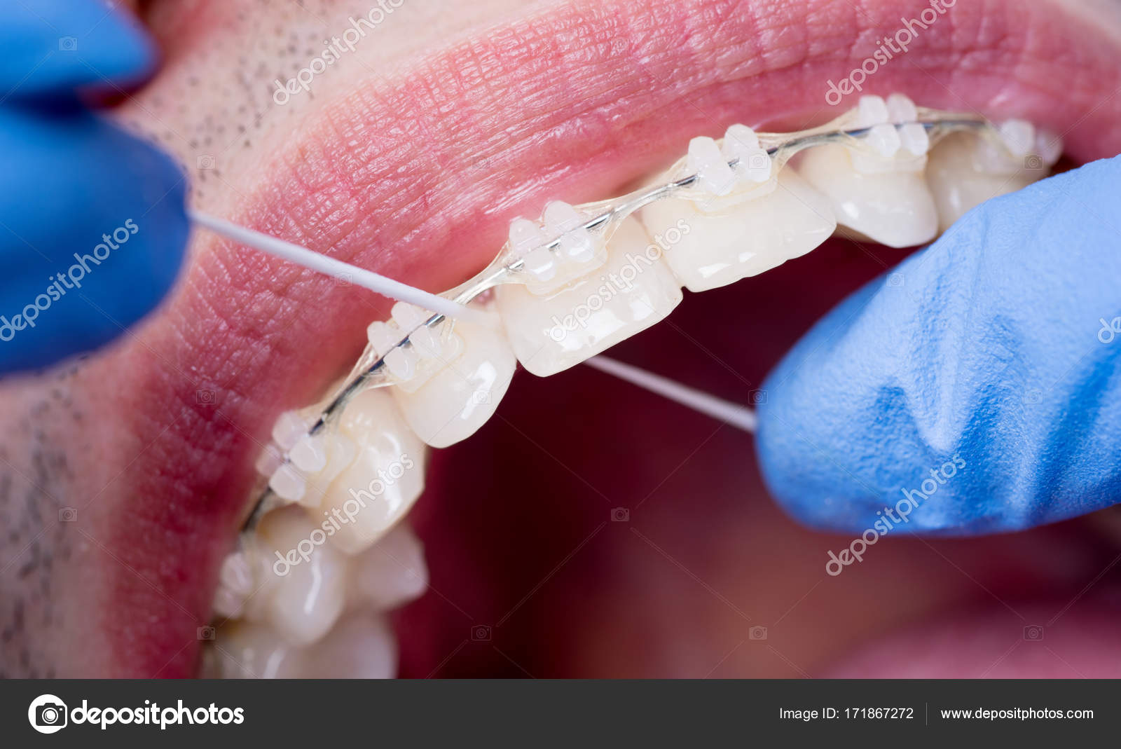 La como brackets dental con usar seda