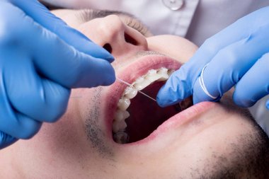 Floss diş ofiste kullanarak seramik destekleri ile Diş Temizleme diş hekimi. Makro çekim diş diş teli ile. Ortodontik tedavi. Oral hijyen ve sağlık. Diş Hekimliği