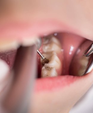 Çocuk diş hekimi diş kliniğinde tedavi Delme sırasında açık ağızlı. Yakın çekim. Diş Hekimliği