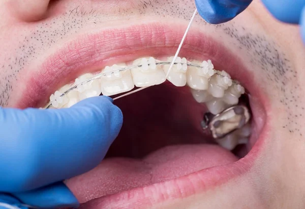 Zahnarzt, der mit Zahnseide in der Zahnarztpraxis Hygienezähne mit Keramikbrackets herstellt. Makroaufnahme von Zähnen mit Zahnspangen. Kieferorthopädische Behandlung. Mundhygiene und Gesundheitsfürsorge. Zahnmedizin — Stockfoto