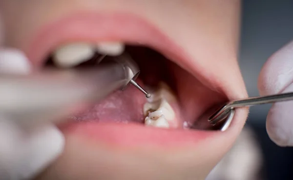 Mundöffnung während der Bohrbehandlung beim Zahnarzt in der Zahnklinik. Nahaufnahme. Zahnmedizin — Stockfoto