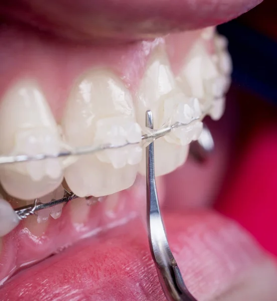 Dentist cleaning teeth with ceramic brackets using dental tool at the dental office. Macro shot of teeth with braces. Orthodontic Treatment. Dentistry — Stock Photo, Image