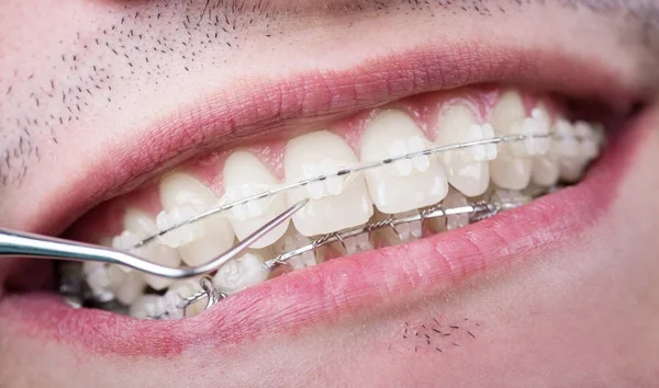 Dentist checking up teeth with ceramic brackets using probe at the dental office. Macro shot of teeth with braces. Orthodontic Treatment. Dentistry — Stock Photo, Image