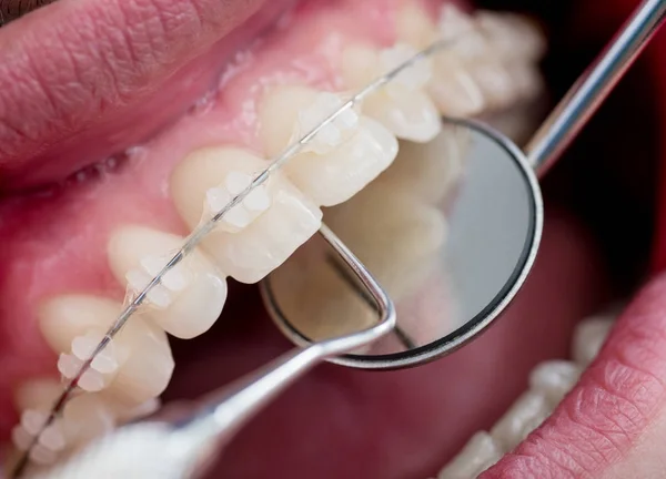 Dentist checking up teeth with ceramic brackets using dental tools - probe and mirror at the dental office. Macro shot of teeth with braces. Orthodontic Treatment. Dentistry — Stock Photo, Image