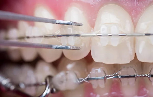 Zahnarzt, der in der Zahnarztpraxis Zähne mit Keramikbrackets mit einer umgekehrten Pinzette untersucht. Makroaufnahme von Zähnen mit Zahnspangen. Kieferorthopädische Behandlung. Zahnmedizin — Stockfoto