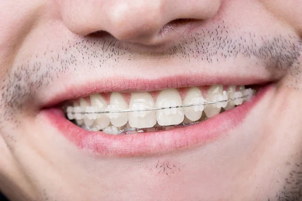 Macro de dientes blancos con aparatos ortopédicos. Paciente masculino sonriente con soportes metálicos en el consultorio dental — Foto de Stock