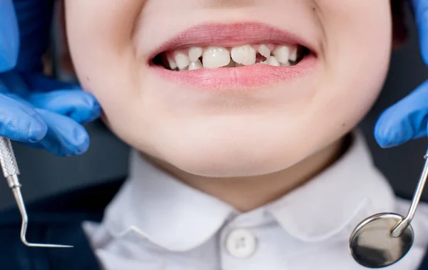 Junge zeigt Zähne bei Zahnuntersuchung. Nahaufnahme der Hand des Zahnarztes mit Zahnwerkzeugen - Sonde und Spiegel in der Zahnarztpraxis. Zahnmedizin — Stockfoto