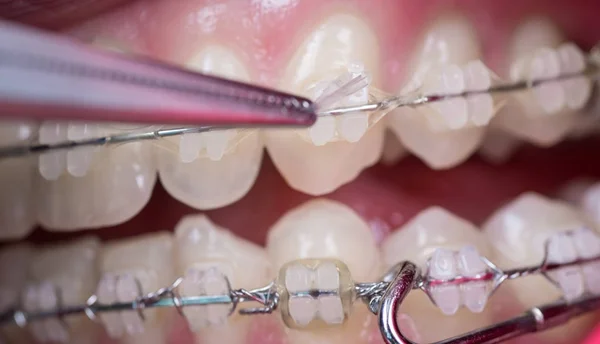 Dentist treating teeth with ceramic brackets, using mosquito at the dental office. Macro shot of teeth with braces. Orthodontic Treatment. Dentistry — Stock Photo, Image