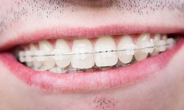Macro-opname van witte tanden met bretels. Glimlachend mannelijke patiënt met metalen haakjes op de tandheelkundige kantoor — Stockfoto