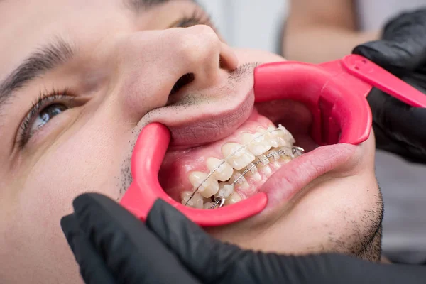 Nahaufnahme weißer Zähne mit Zahnspange und Zahnspange in der Zahnarztpraxis. Kieferorthopädische Behandlung. Zahnmedizin — Stockfoto