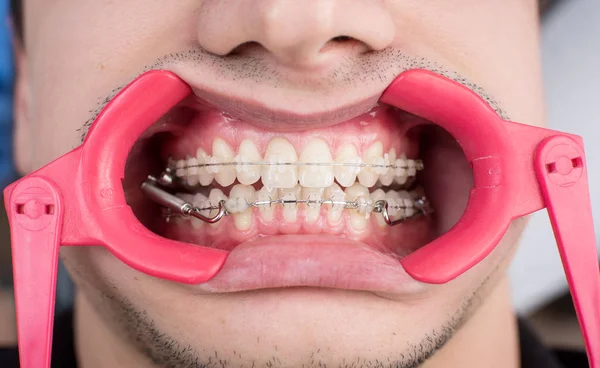 Macro shot of white teeth with braces and dental retractor at the dental office. Orthodontic Treatment. Dentistry — Stock Photo, Image