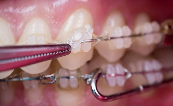 Zahnarzt, der Zähne mit Keramikbrackets behandelt, mit Moskitos in der Zahnarztpraxis. Makroaufnahme von Zähnen mit Zahnspangen. Kieferorthopädische Behandlung. Zahnmedizin — Stockfoto