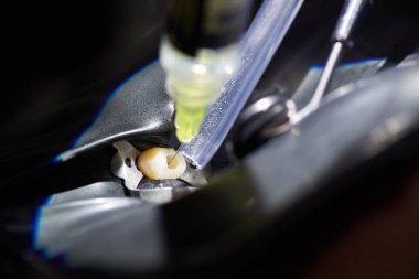 Bir doktor tarafından gerçekleştirilen bir diş enjeksiyon closeup