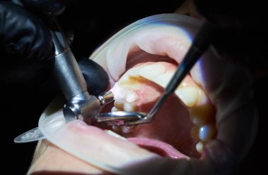 Diş parlatma, yakın çekim. Modern kliniğinde diş Hizmetleri. Modern stomatology kavramı