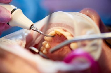 İstemcinin diş ölçekli ve diş bir ofiste cilalı closeup.