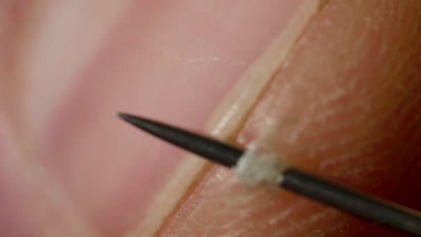 La main humaine est percée par l'aiguille avec l'aiguille d'acupuncture — Video