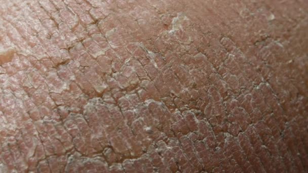 Close-up of a human dry skin on the heels of the macro — Stock Video