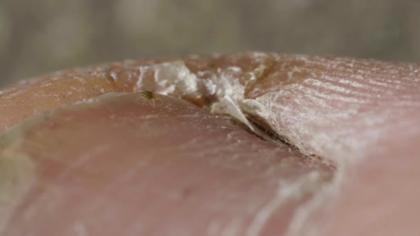 Ongle malade sur la jambe, champignon sur le gros orteil — Video