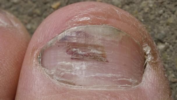 Больной гвоздь на ногу, грибок на большой палец — стоковое видео