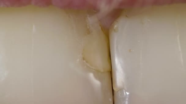 Voorste tand met tandsteen en vullingen voor tandheelkundige behandeling — Stockvideo