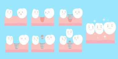 cartoon tooth implant smile happily clipart