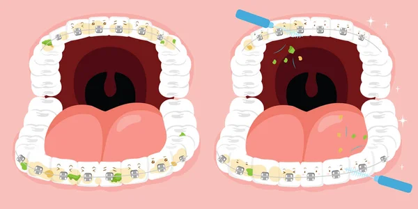 Problemy z czyszczeniem zębów — Wektor stockowy