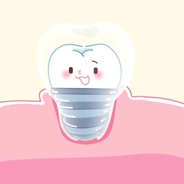 Schattige cartoon tandheelkundige implantaten — Stockvector