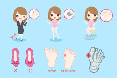 woman with hallux varus clipart