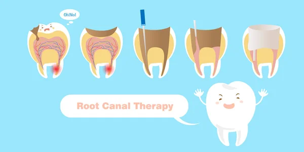 Dente com terapia de canal radicular —  Vetores de Stock