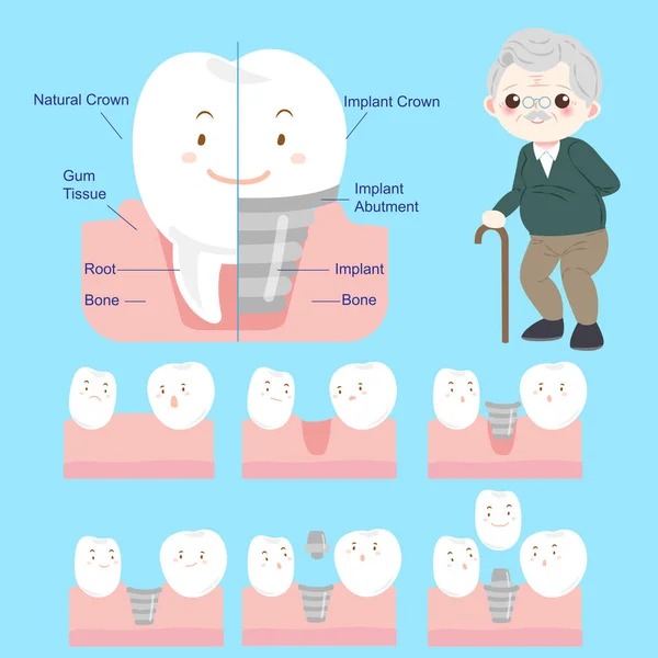 Старик с имплантированным зубом — стоковый вектор