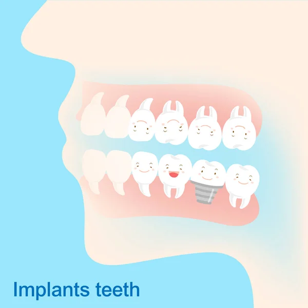 Kreslený implantáty zubů — Stockový vektor