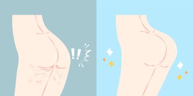 kalça plastik cerrahi kavramı ile