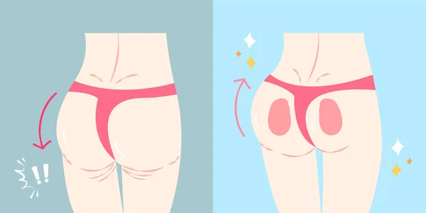Woman with butt implant — Διανυσματικό Αρχείο