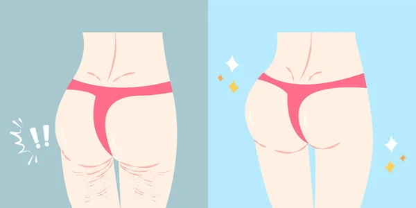 Fesses avec concept de chirurgie plastique — Image vectorielle