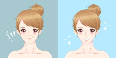 kadın nazolabial kıvrım problem ile