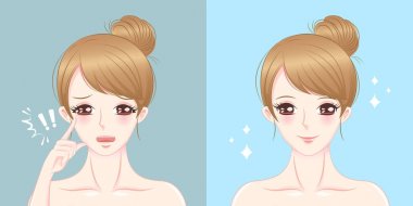 kadın sarkık göz ile