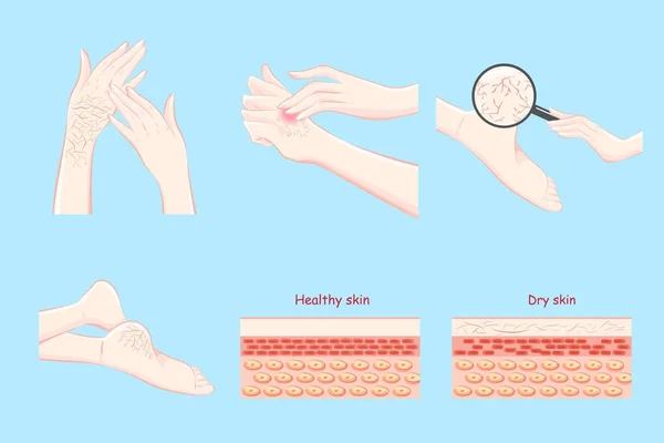 Saludable con el concepto de piel seca — Archivo Imágenes Vectoriales