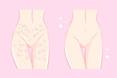 stretch mark cilt kadınla