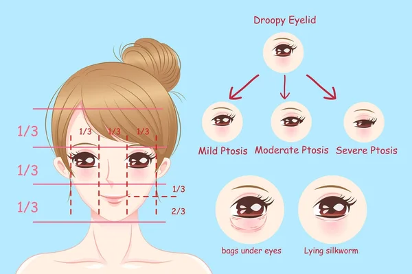 kadın sarkık göz kapakları ile