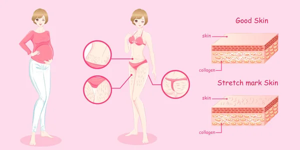 스트레치 마크 피부를 가진 여자 — 스톡 벡터