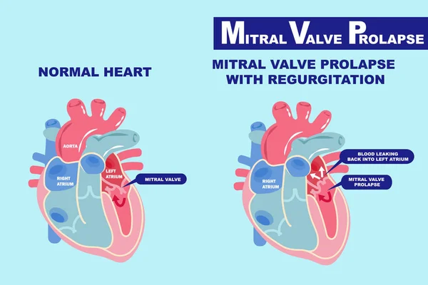 Heart Mitral Valve Prolapse Blue Background — Stock Vector