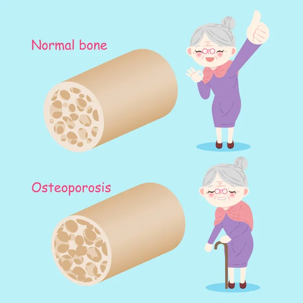 Stará žena s osteoporózou — Stockový vektor