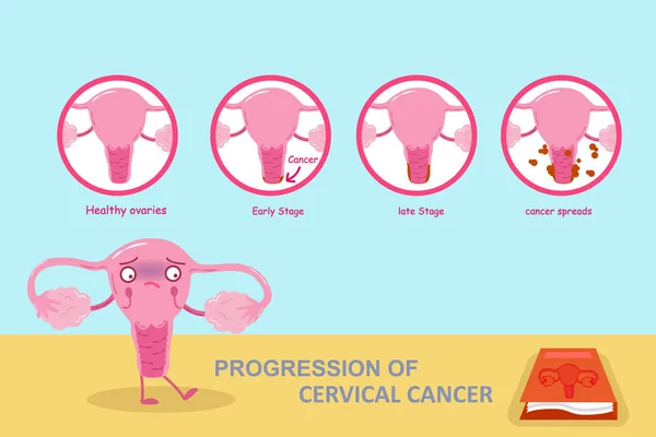 Progressione del cancro della cervice uterina — Vettoriale Stock