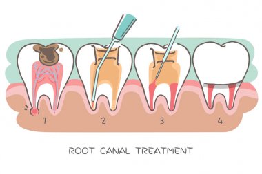 tooth with root canal treatment clipart