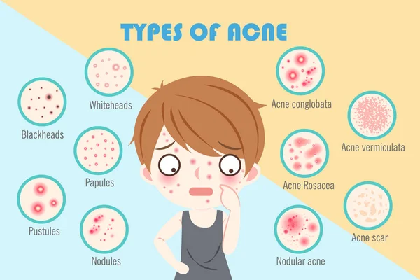 Menino com tipos de acne —  Vetores de Stock