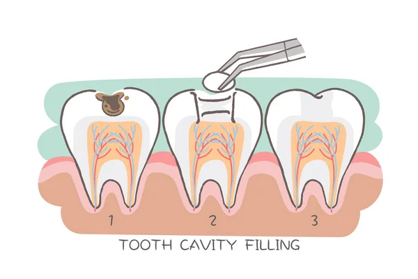 Vyplnění dutiny zubu — Stockový vektor