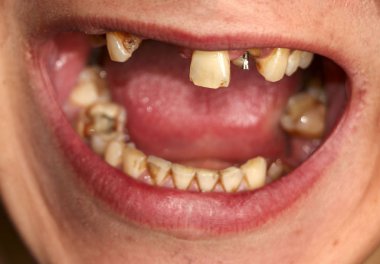 Ağzı kırık, dişleri hastalıklı. Caries ve periodontitis 'ten etkilenmiş. Diş kaplaması takmak için sakızda çelik çivi var. Nikotin plağıyla kaplanmış sigara içen birinin dişleri..