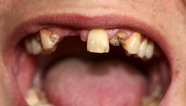 Ağzı kırık, dişleri hastalıklı. Caries ve periodontitis 'ten etkilenmiş. Diş kaplaması takmak için sakızda çelik çivi var. Nikotin plağıyla kaplanmış sigara içen birinin dişleri..